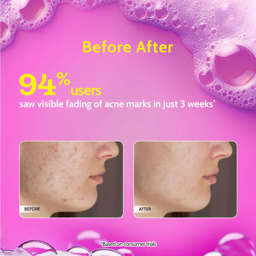 Chemist at play 2% Salicylic Acid Face Wash for Acne & Oil Control - 100 ml